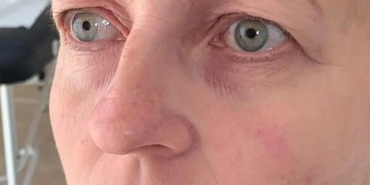 Cheek and under-eye area before and after cheek filler, after