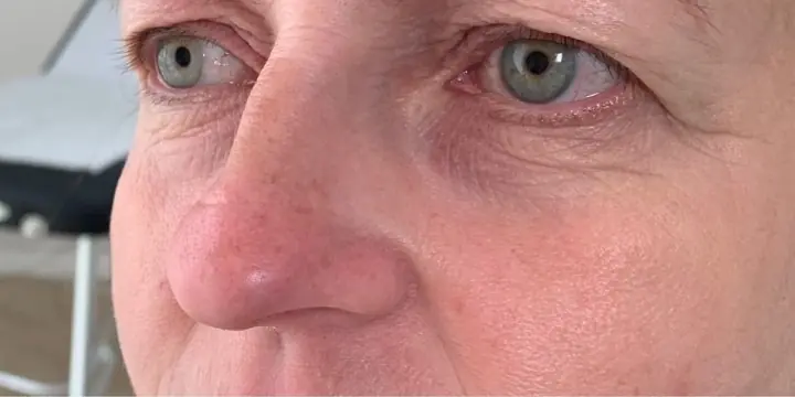 Cheek and under-eye area before and after cheek filler, before