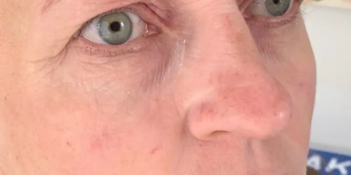 Cheek and under-eye area before and after cheek filler, after