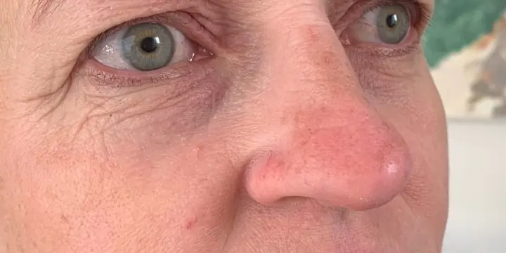Cheek and under-eye area before and after cheek filler, before