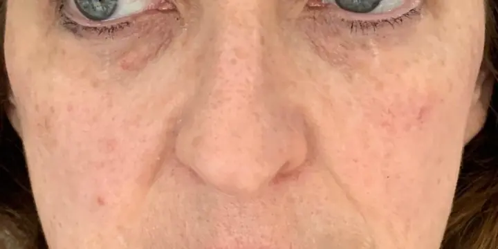 Mid face before and after cheek filler, after