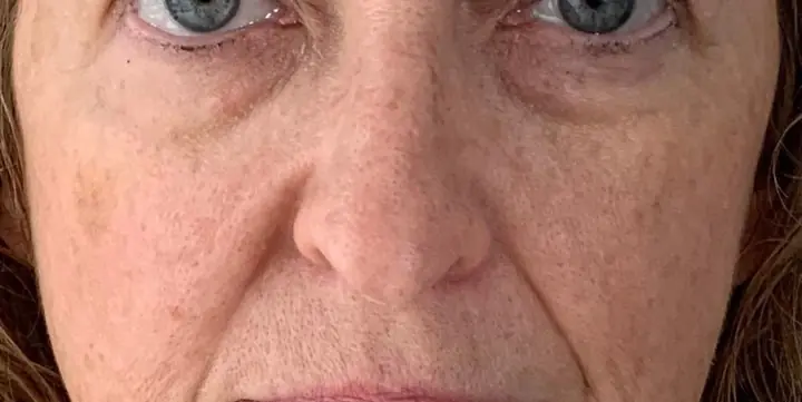 Mid face before and after cheek filler, before