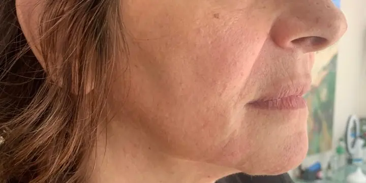 Lower face in profile before and after chin and jaw filler, after