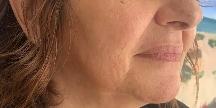 Lower face in profile before and after chin and jaw filler, before