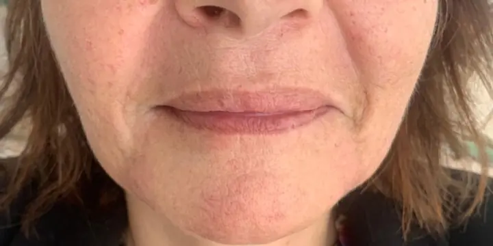 Lower face before and after chin and jaw filler, after