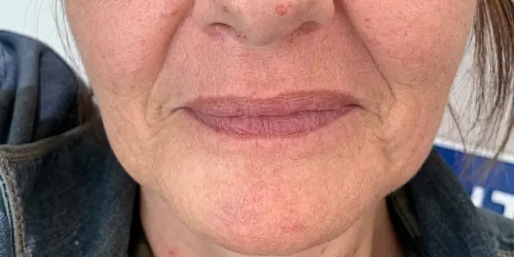 Lower face before and after chin and jaw filler, before
