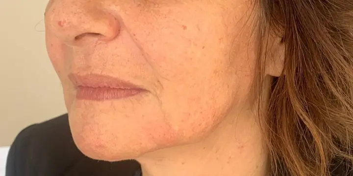 Lower face in profile before and after chin and jaw filler, after