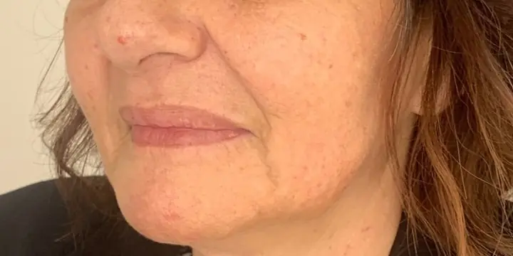 Lower face in profile before and after chin and jaw filler, before
