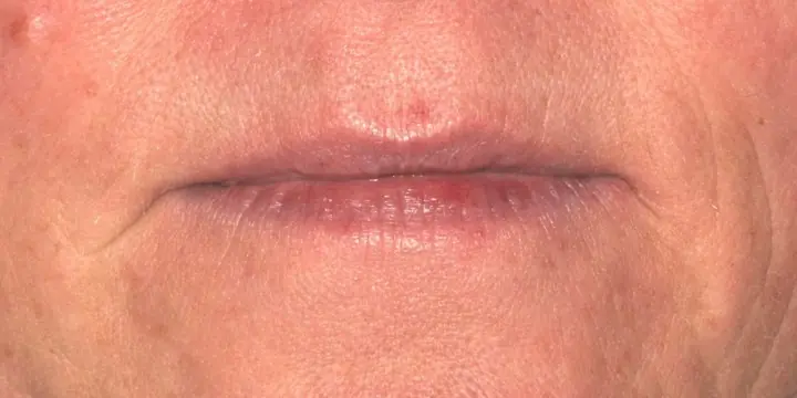 Lips before and after lip filler, after