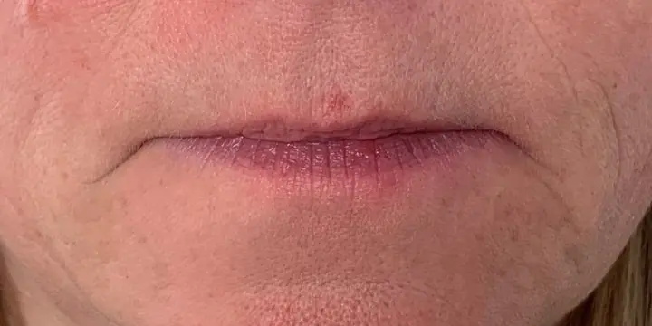 Lips before and after lip filler, before