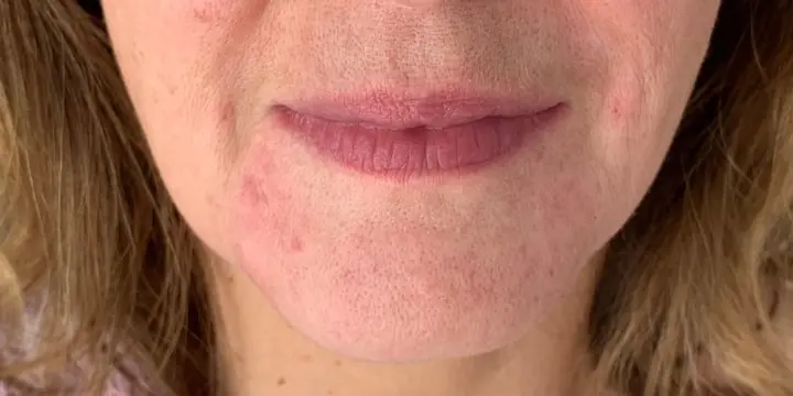 Mouth and lower face before and after marionette lines, after