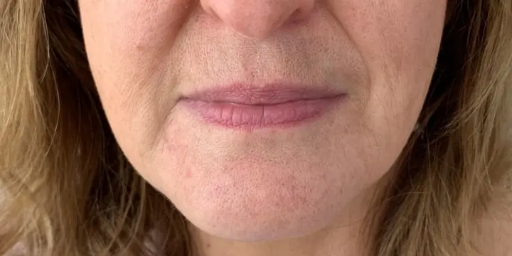 Mouth and lower face before and after marionette lines, before