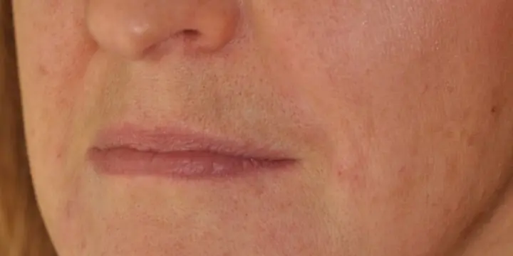 Mouth and lower face before and after marionette lines, after