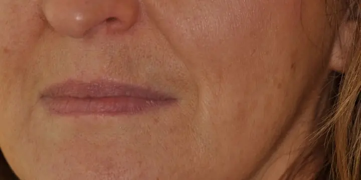 Mouth and lower face before and after marionette lines, before