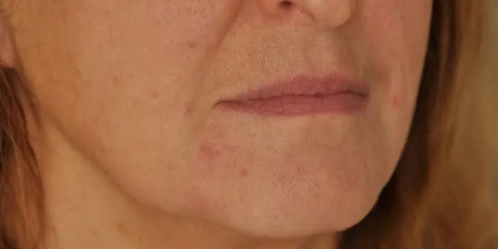 Mouth and lower face before and after marionette lines, after