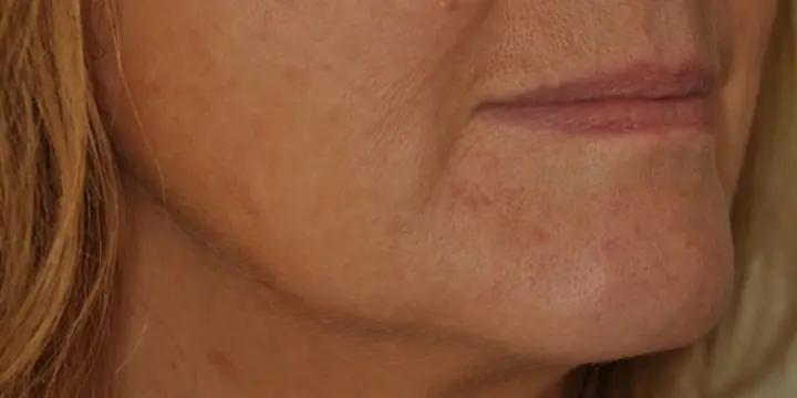 Mouth and lower face before and after marionette lines, before