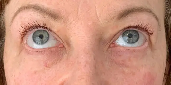 Under-eye area before and after tear trough filler, after