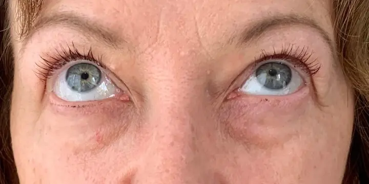 Under-eye area before and after tear trough filler, before