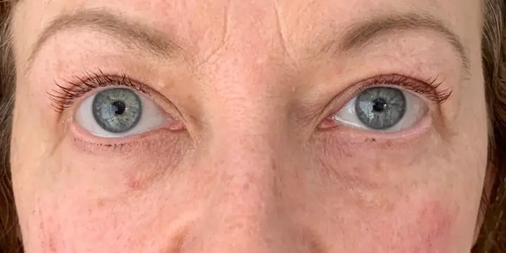 Under-eye area before and after tear trough filler, after