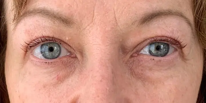 Under-eye area before and after tear trough filler, before
