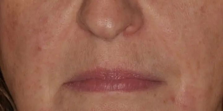 Mouth and nasolabial area before and after lines around the mouth, after