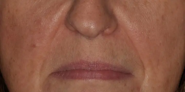 Mouth and nasolabial area before and after lines around the mouth, before