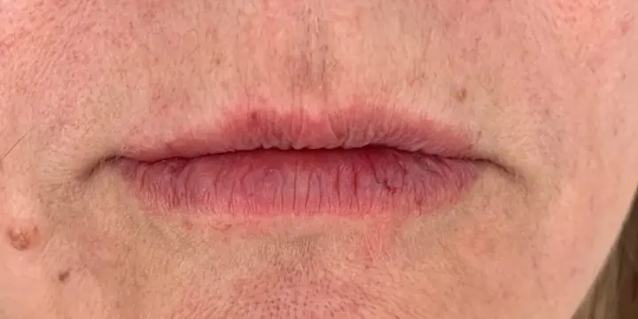 Lips and the lines around them before and after lines around the mouth, after