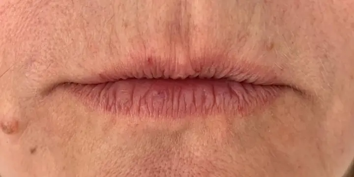 Lips and the lines around them before and after lines around the mouth, before